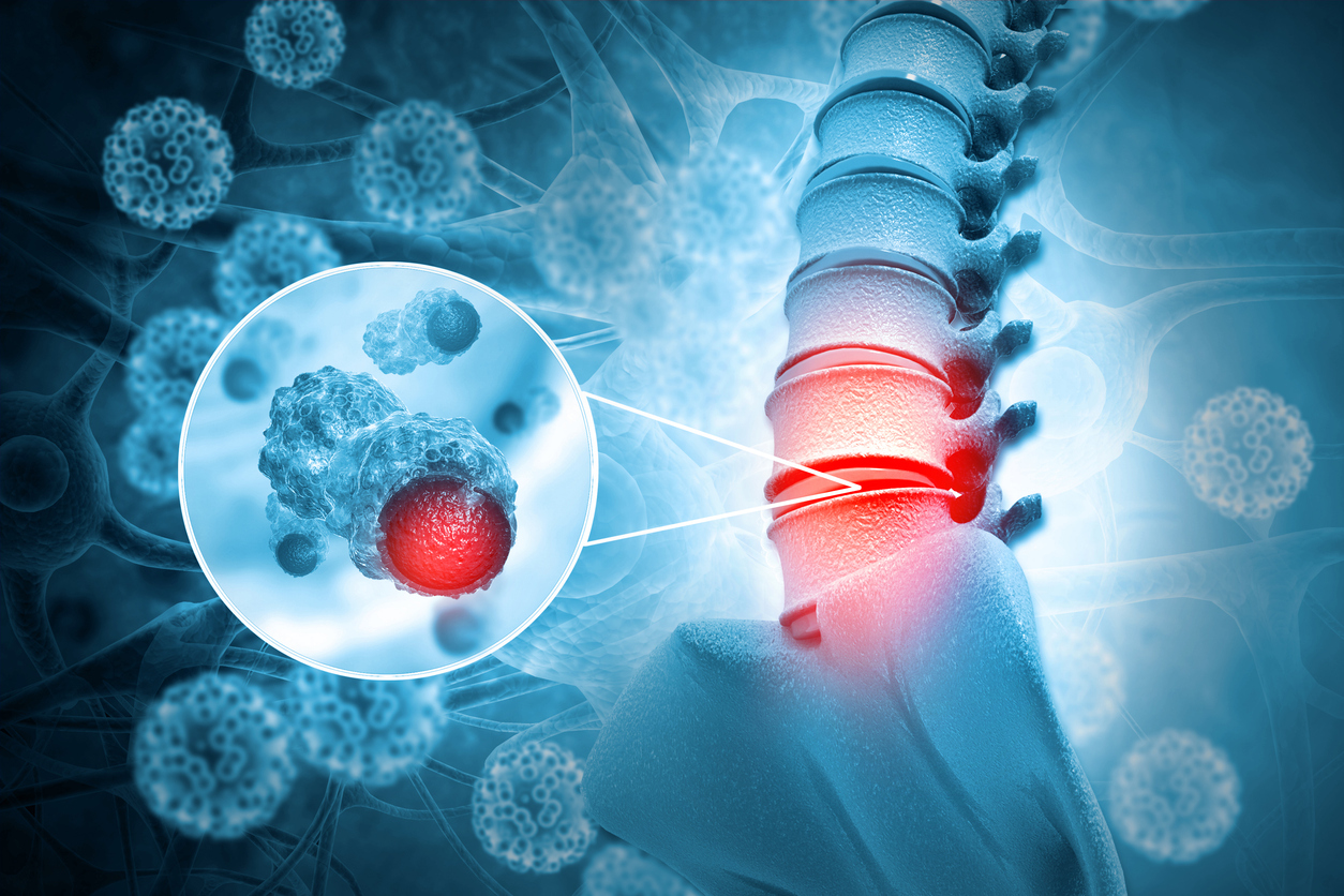 Vertebral Bone Tumors