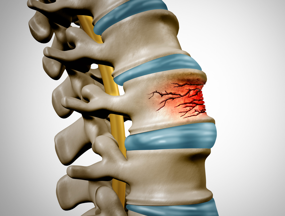 Vertebral Compression Fractures