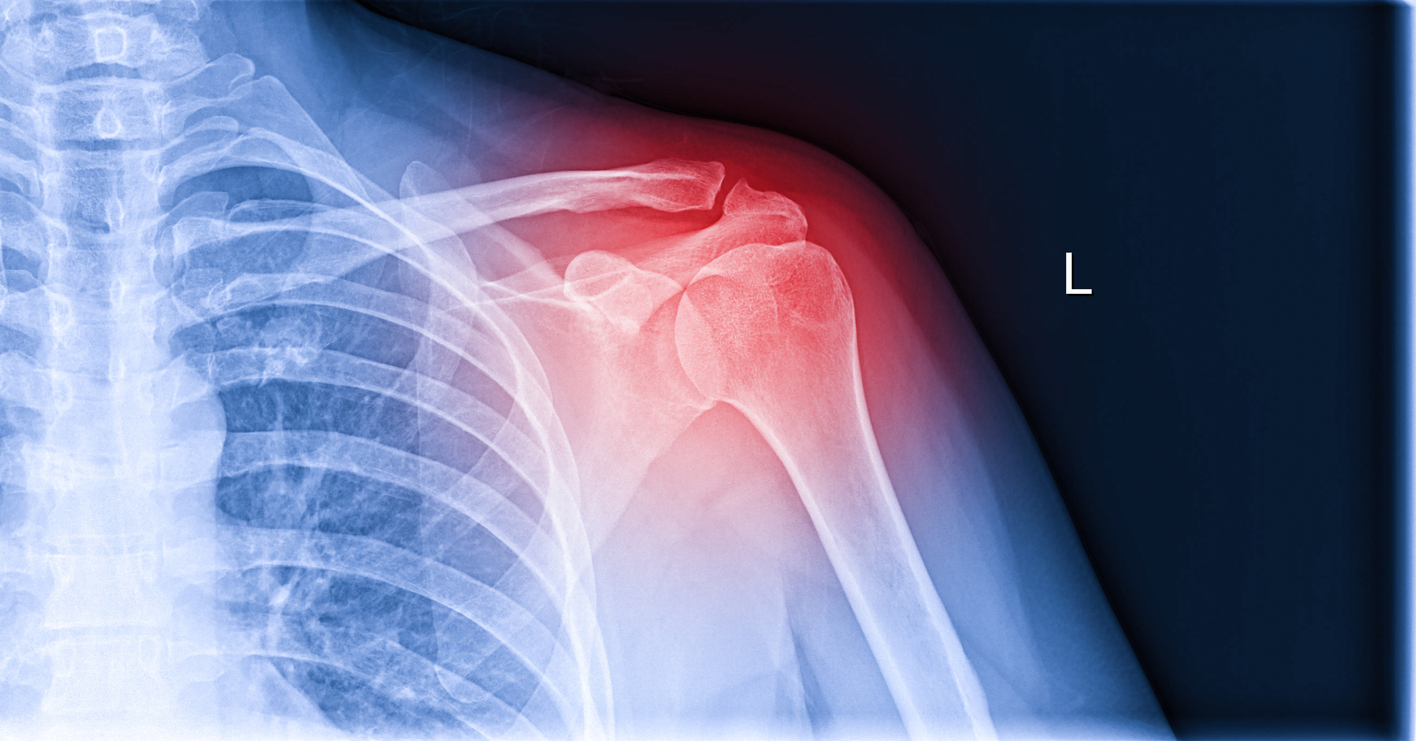 Rotator Cuff Injuries